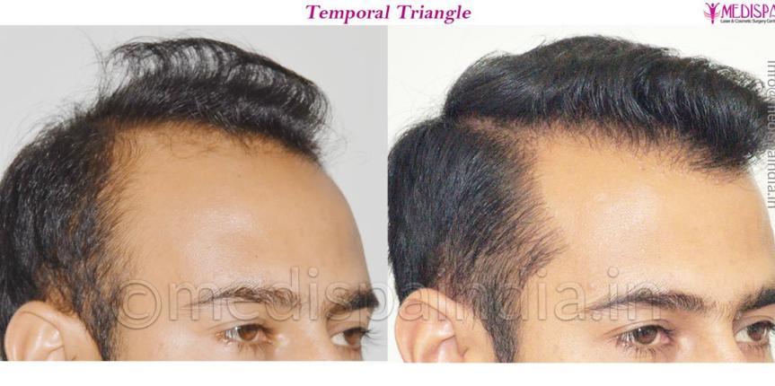 hyderabad hair restoration