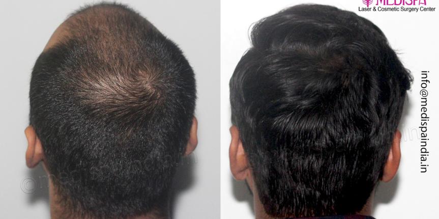 best 1 years hair transplant result