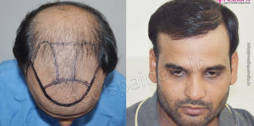 best hair transplant clinics in ahmedabad