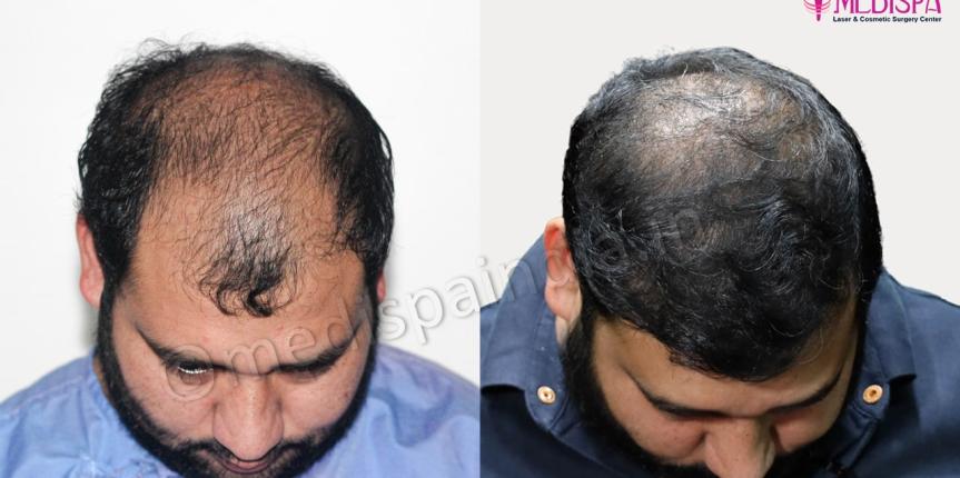 hair transplant