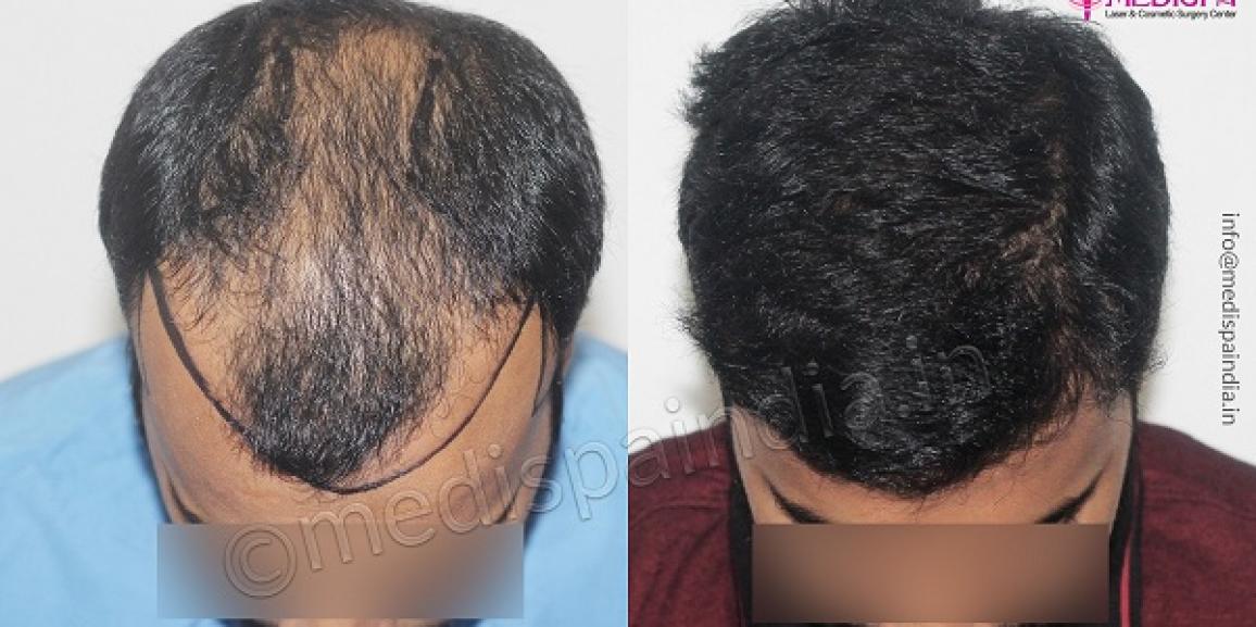 Why is India The Most Preferred Destination For Hair Transplant?