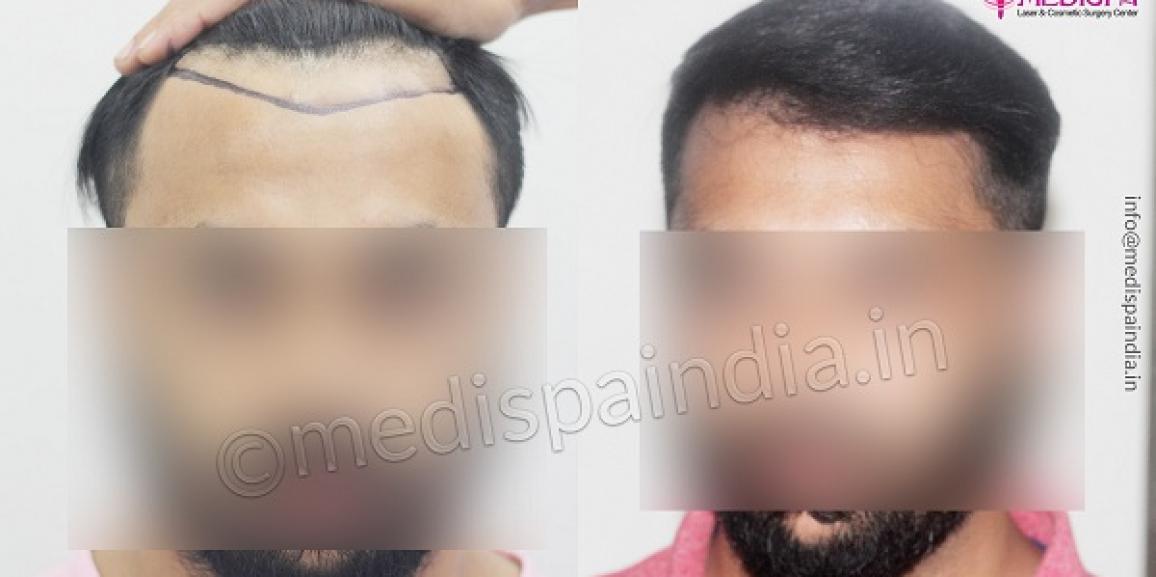 How To Take Care Of The Donor Area After Hair Transplant?