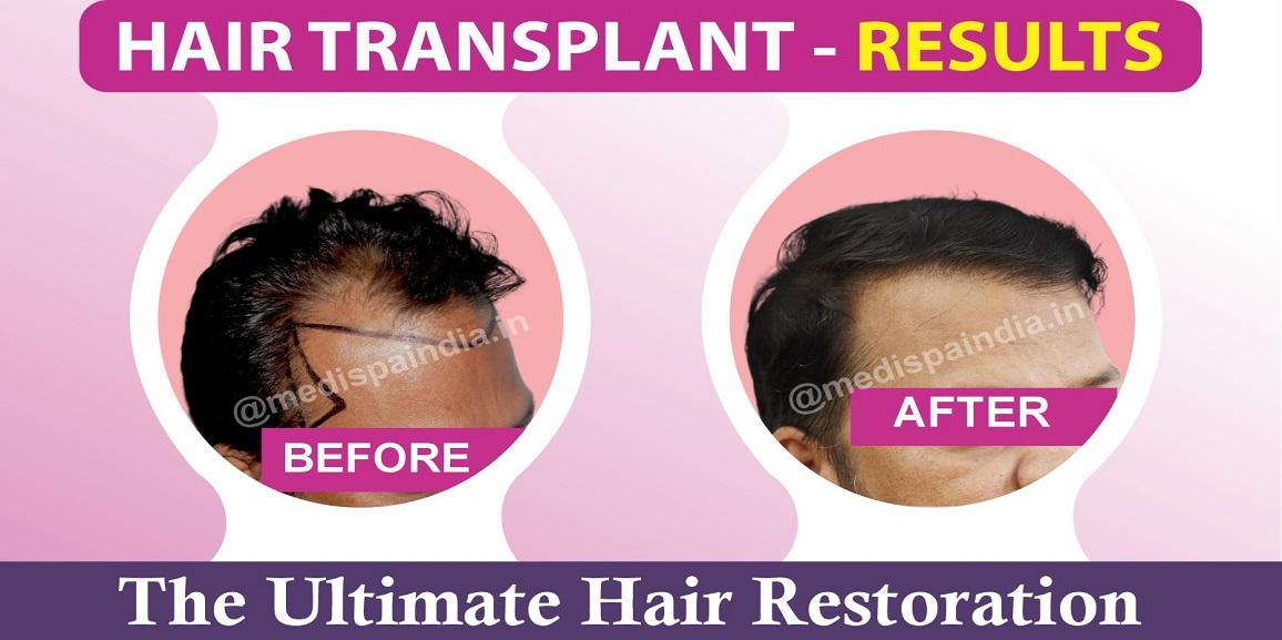 Suffering From Baldness Issue? How Hair Transplant Can Help?