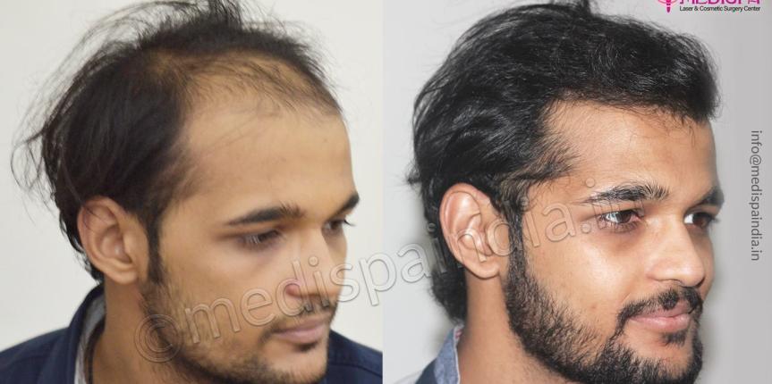 hair transplant surgeons in new-zealand