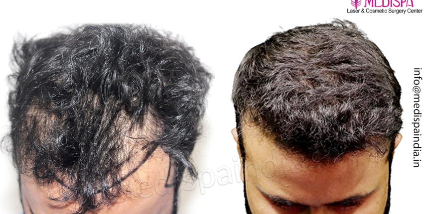 hair transplant jaipur india results