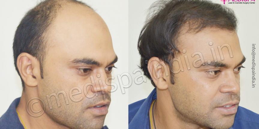 rajashan hair transplant clinic