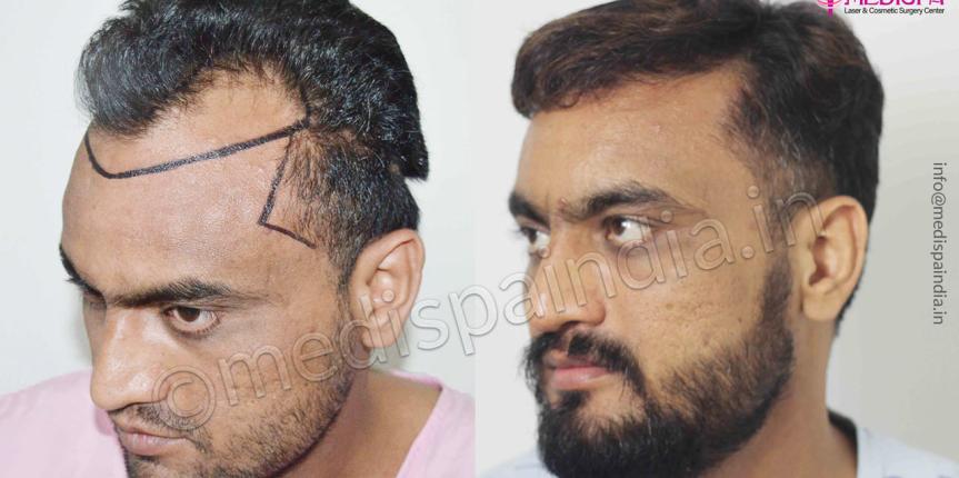 hair transplant surgeons in australia