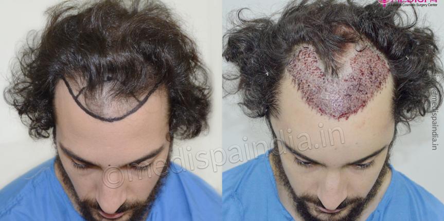 usa hair restoration patient result