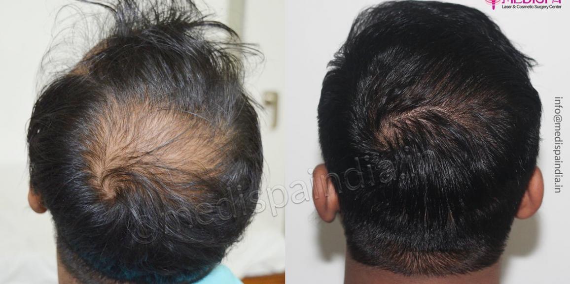 Guidelines To Choose The Best Clinic For Hair Transplant Treatment