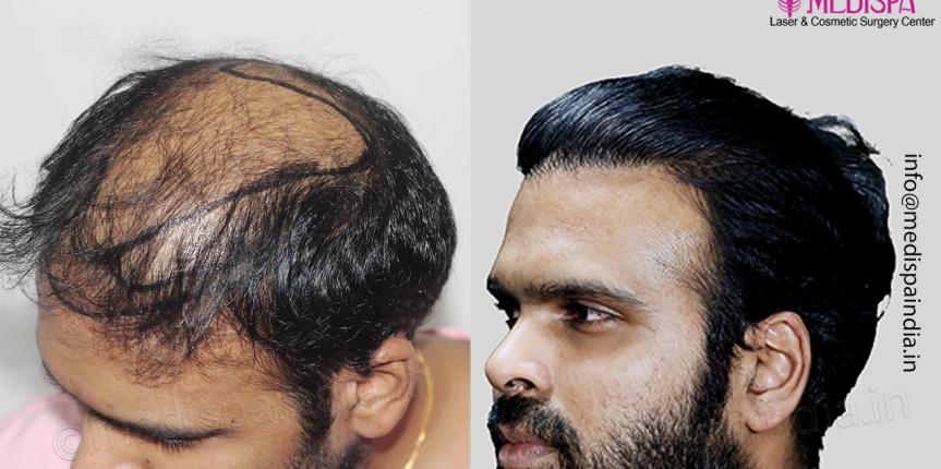 hair transplant results after 1 year