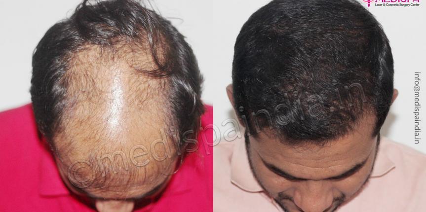 best hair transplant results Hyderabad