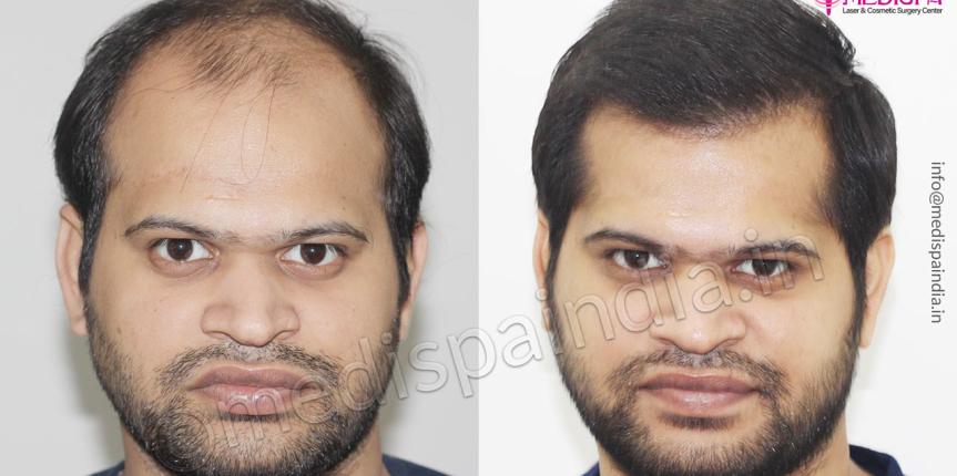 hair transplant in bikaner