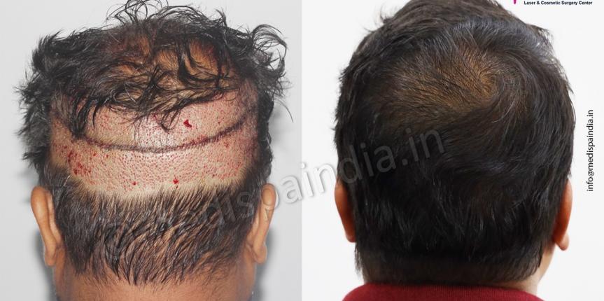 hair transplant price in india