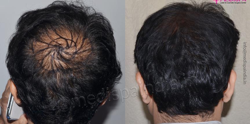 vertex hair transplant results india