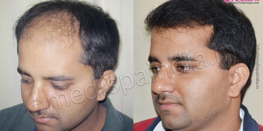 hair transplant cost in turkey