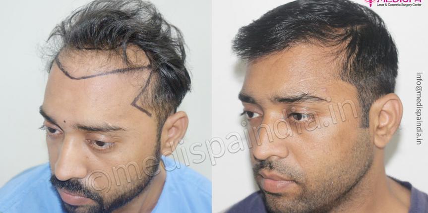 wrong hair transplant correction-in-delhi