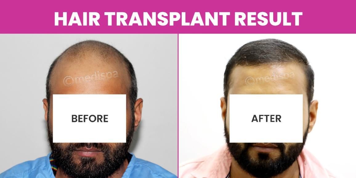 How Is The Effectiveness Of A Hair Transplant Procedure Measured?