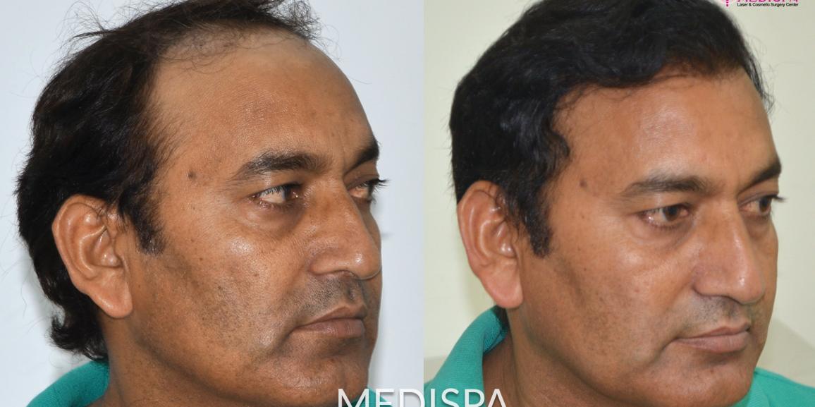 Benefits of Getting the Combined Technique of Hair Transplant