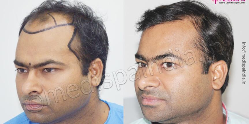 hair transplant results uk