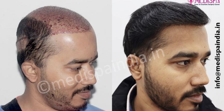 wrong hair transplant repair in india
