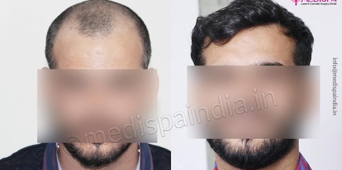 Steps To Get A Successful Hair Transplant Surgery