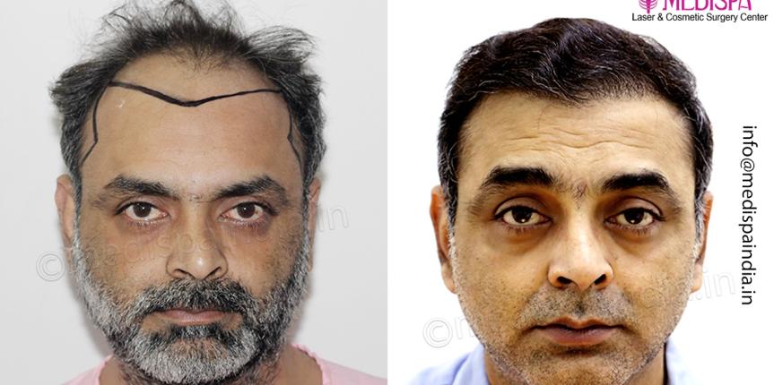best hair transplant result india