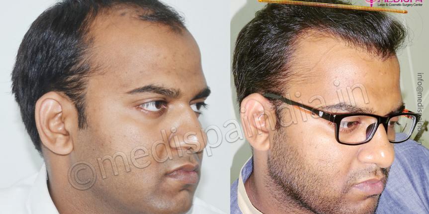 hair transplant cost in jaipur rajasthan