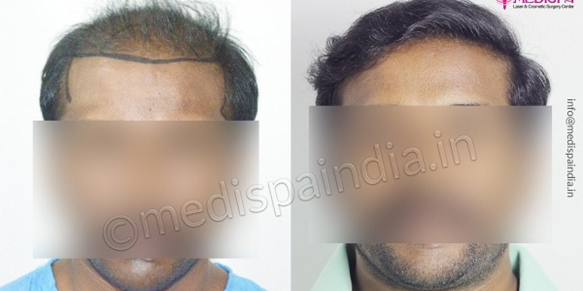 How To Get Safe Hair Transplant Treatment For Hair Loss Issue?