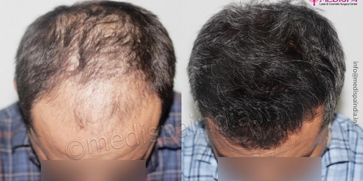 Why Choose India As The Primary Destination For Hair Transplant?