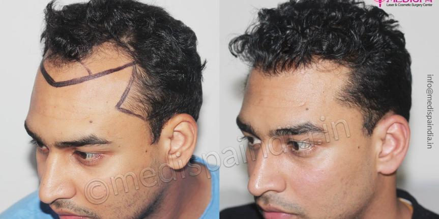 results hair transplant india