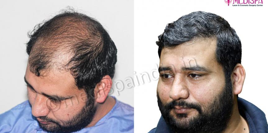 best hair restoration india results