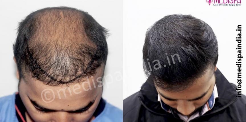 bad hair transplant repair in jaipur