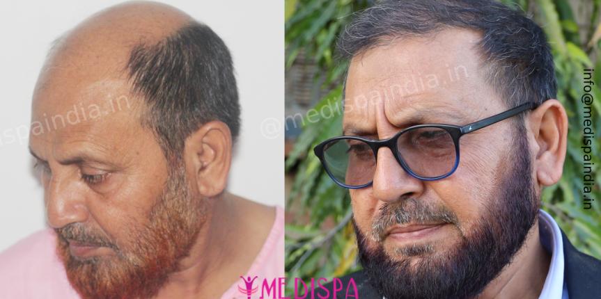 hair transplant cost india