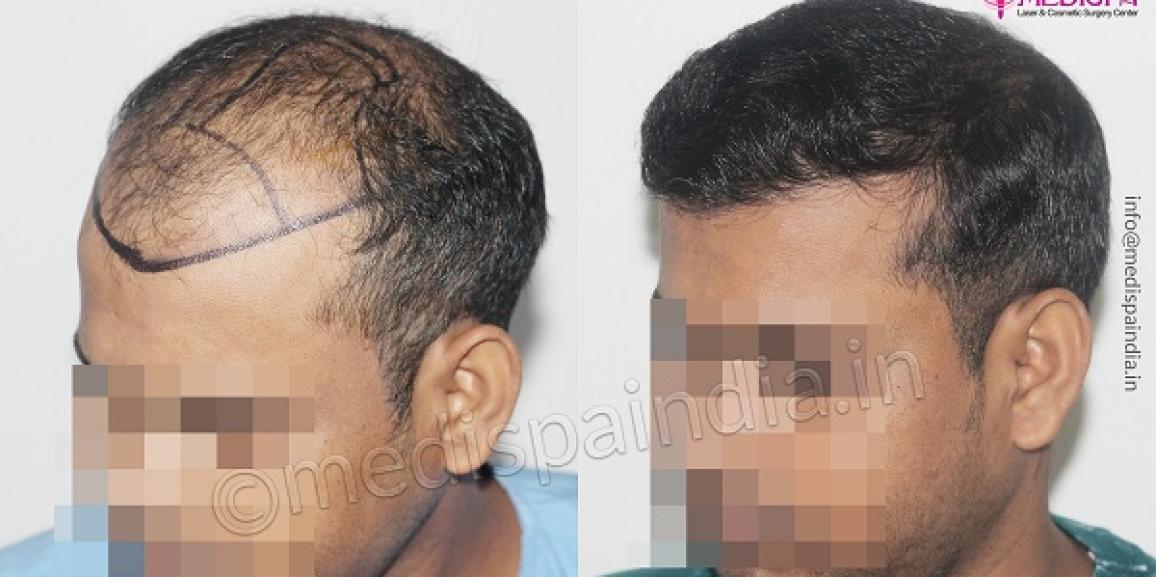 Is It Possible To Get Scarless Hair Transplant Treatment?