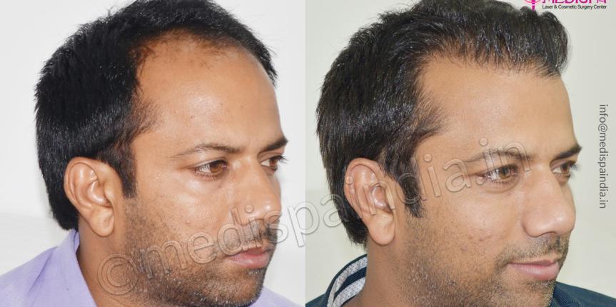 hair transplant cost in gurugram