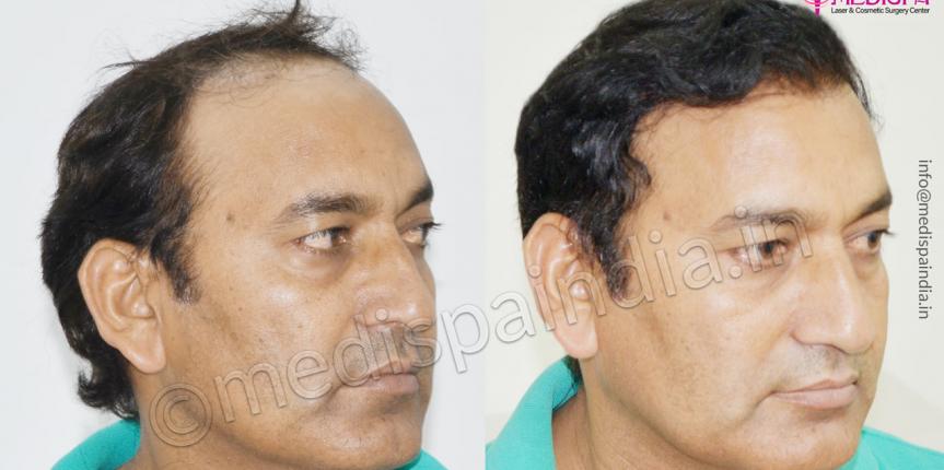 hair transplant south delhi