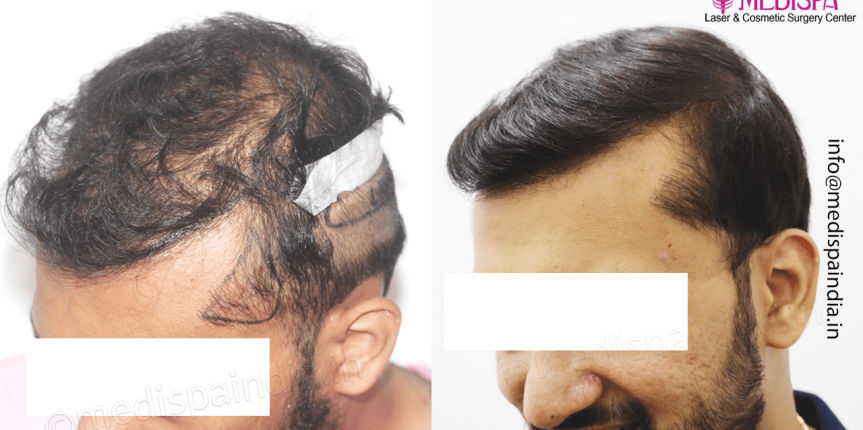 best-hair-restoration-delhi-india