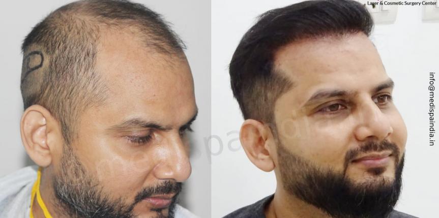 hair transplant in delhi