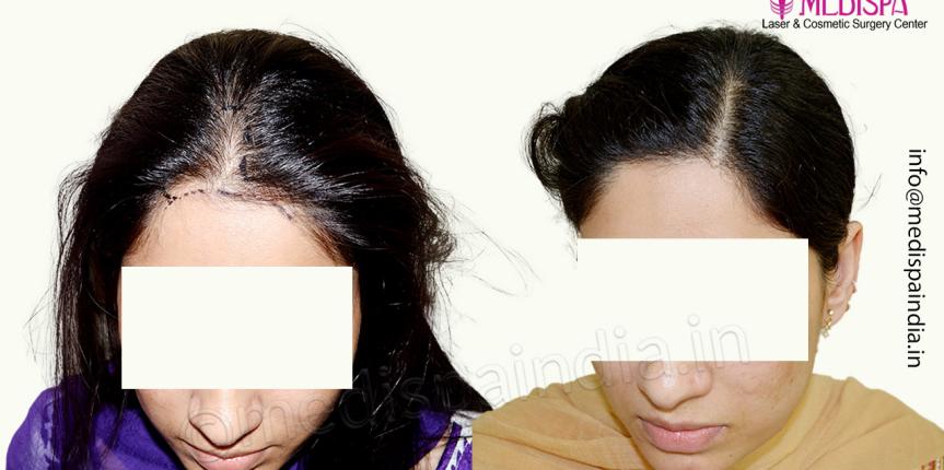 female hair transplant india