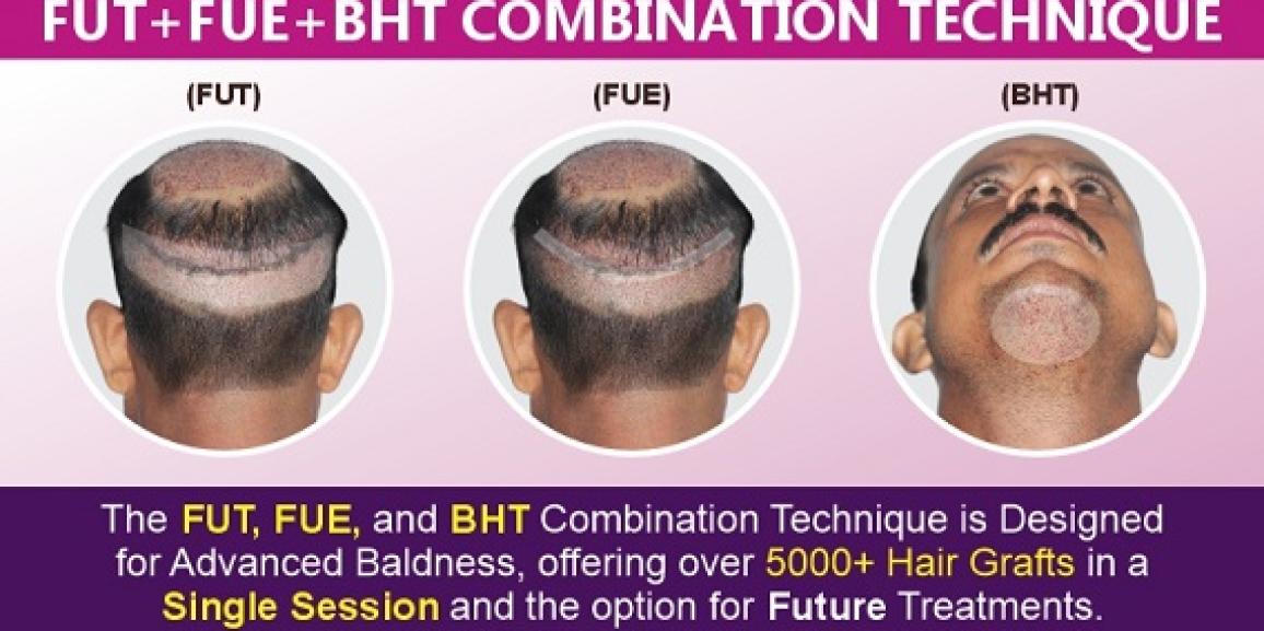 Explain The Importance of FUT+FUE+BHT Hair Transplant Technique