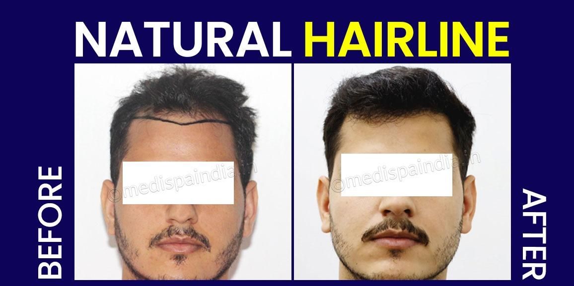 Hair Transplant Recovery: Tips And Tricks For A Smooth Healing Process