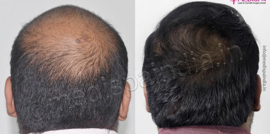 hair transplant in gurugram