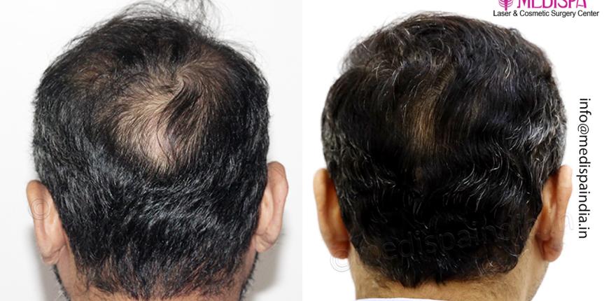 best hair transplant result london