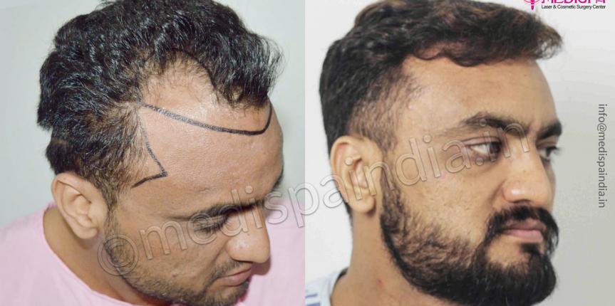 hair transplant in australia