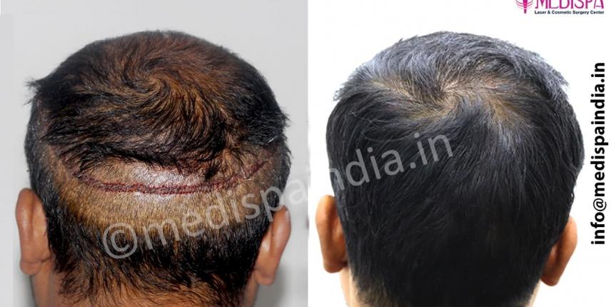 hair transplant repair in jaipur