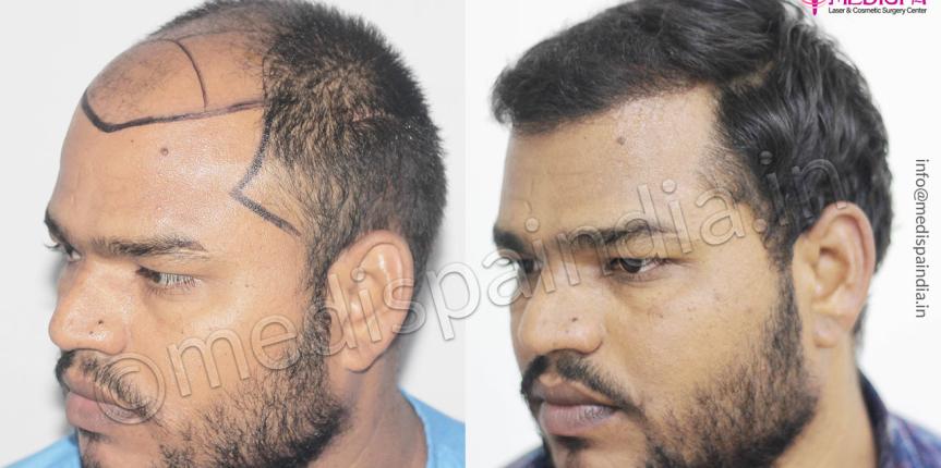 hair transplant cost in nigeria