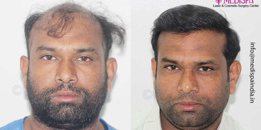 hair transplant results India