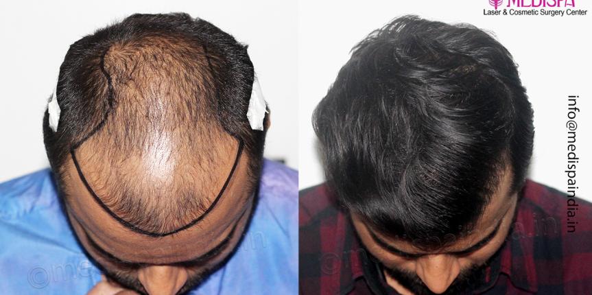 1 year hair transplant results