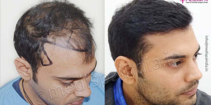 hair transplant clinics in chandigarh