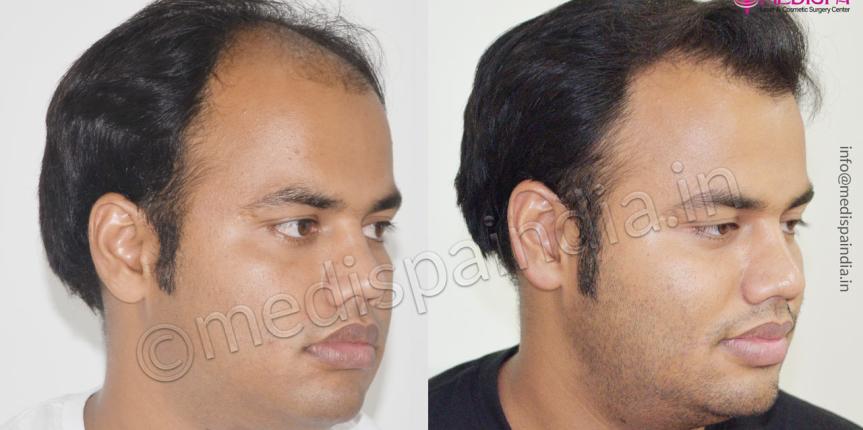 best hair transplant rajasthan